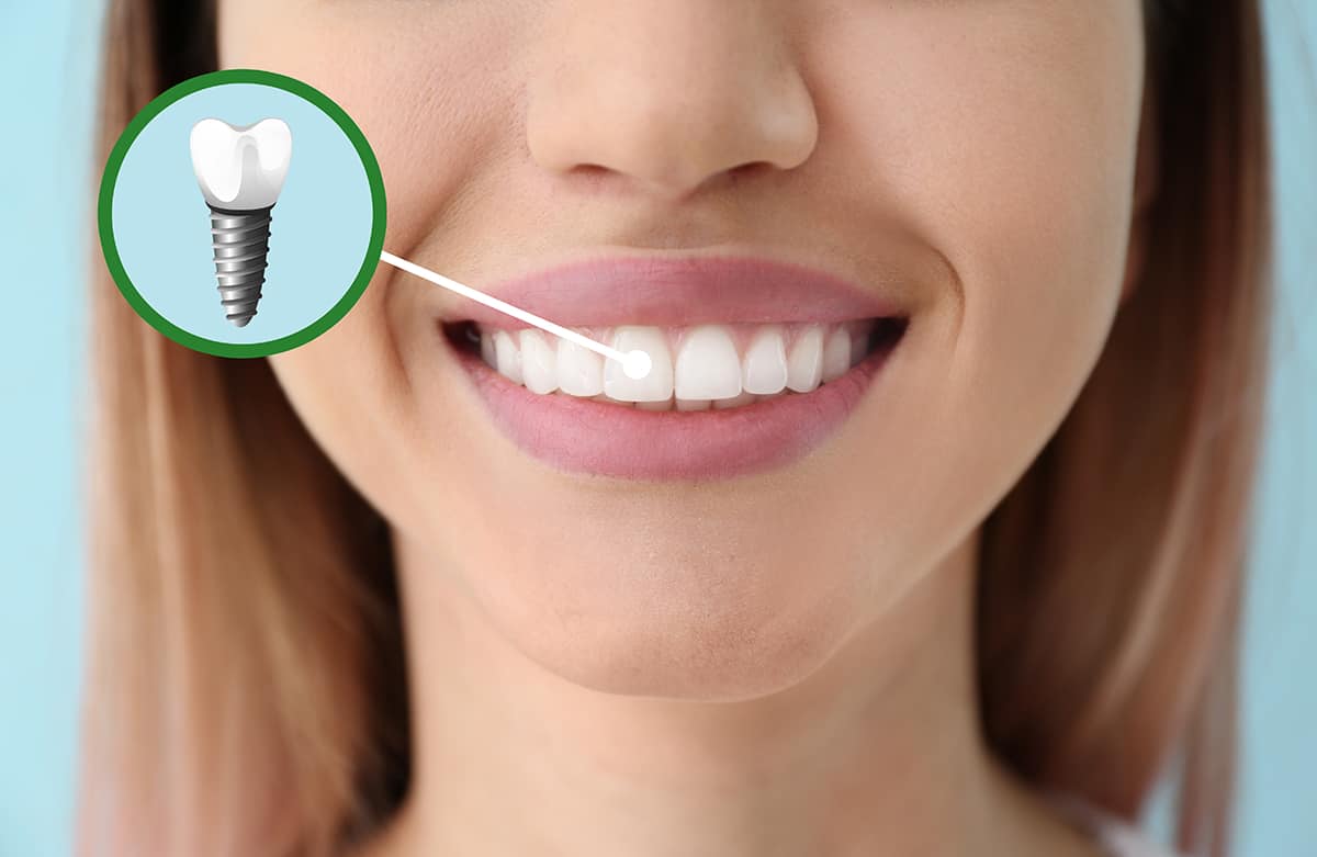 Dental Implants